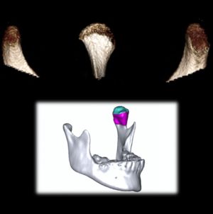 Volumetria Condilar