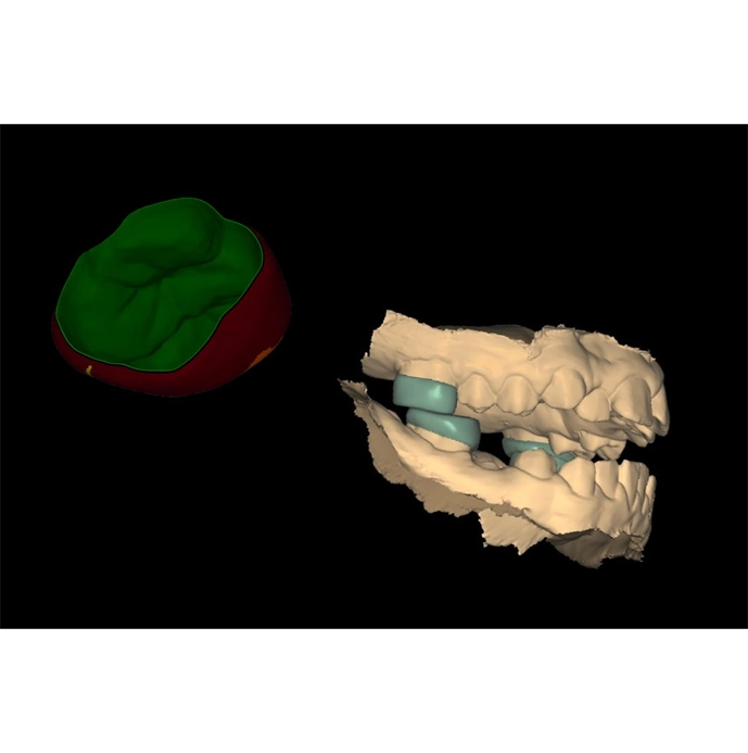 Orthokinetic Onlays